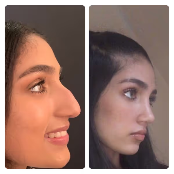 Nose Aesthetics (Rhinoplasty) in Turkey